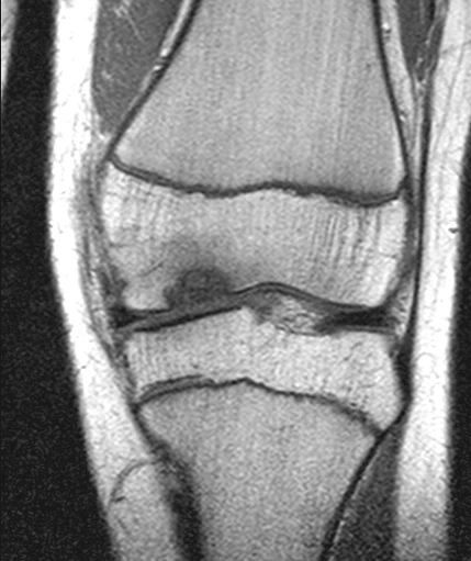 Osteokondroosin esiintyvyydessä selviä rotueroja